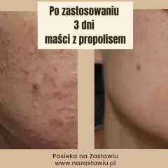 Przed i po zastosowaniu maści z propolisem na rany. Skóra po 3 dniach kuracji jest widocznie zdrowsza.