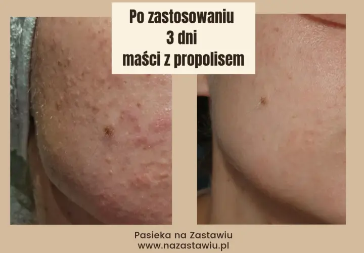 Przed i po zastosowaniu maści z propolisem na rany. Skóra po 3 dniach kuracji jest widocznie zdrowsza.