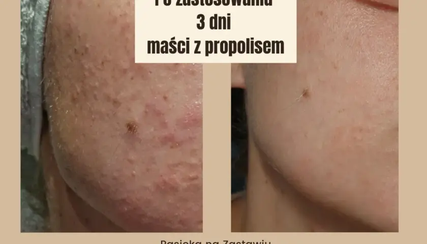 Przed i po zastosowaniu maści z propolisem na rany. Skóra po 3 dniach kuracji jest widocznie zdrowsza.