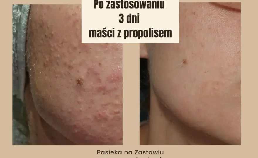 Propolis na rany - kiedy pomaga, a kiedy lepiej odpuścić