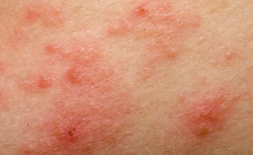 Uczulenie na miód - objawy, pomoc i diagnostyka