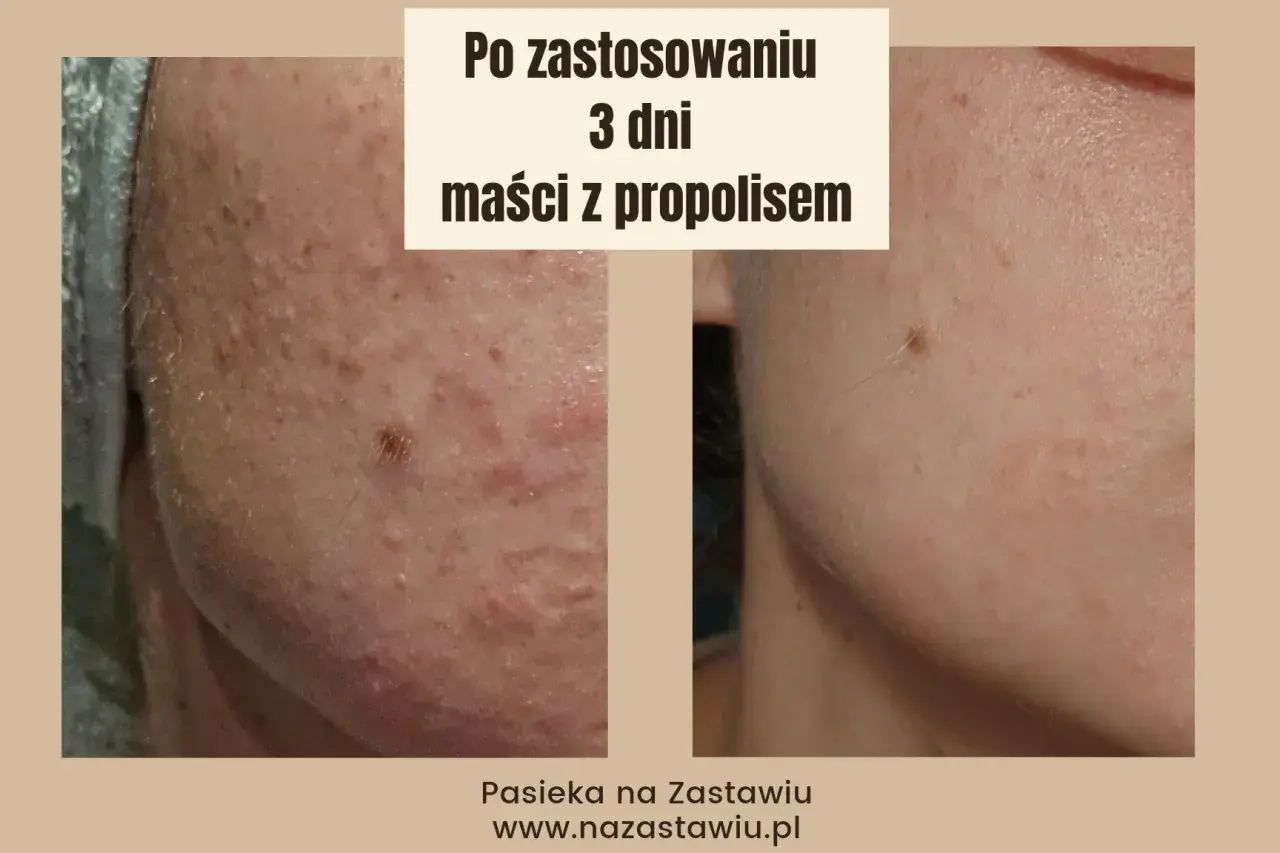 Przed i po zastosowaniu maści z propolisem na rany. Skóra po 3 dniach kuracji jest widocznie zdrowsza.
